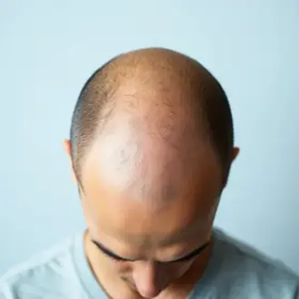Calvície masculina causas e tratamento: o que saber, cuidados e quando buscar orientação