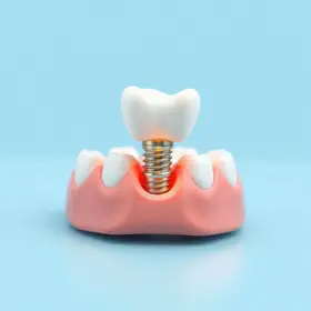 Quanto custa implante dentário: como funciona, custos e cuidados ao escolher