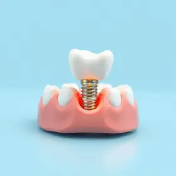 Quanto custa implante dentário: como funciona, custos e cuidados ao escolher